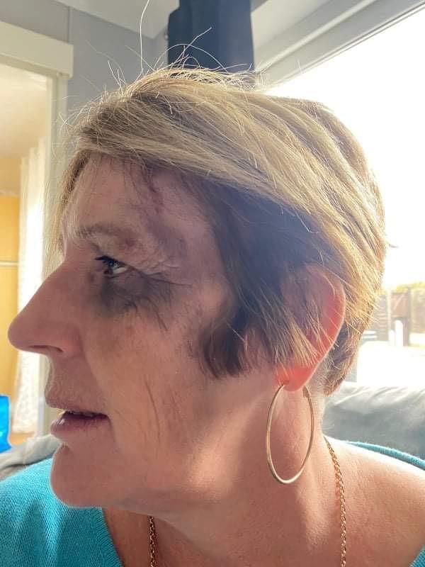 Gazette: Diane Redburn after being attacked in her car