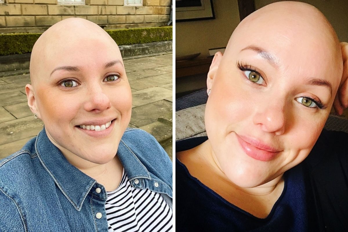 Manningtree campaigner with alopecia fighting to stop the stare - Vimarsana News